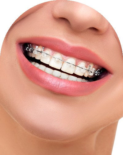 Braces in Royal Palm Beach, West Palm Beach, and Lantana, FL Braces in Royal Palm Beach, West Palm Beach, and Lantana, FL